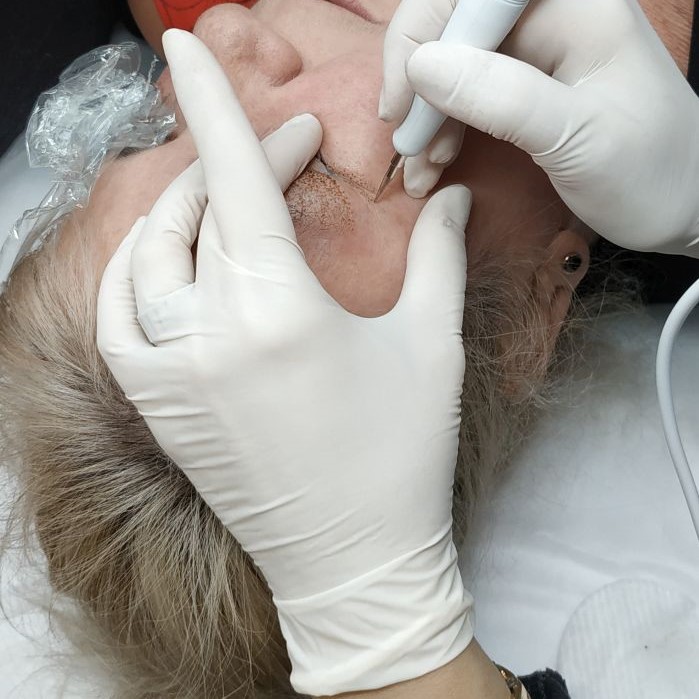 termikus ionizacio plazma Budapest