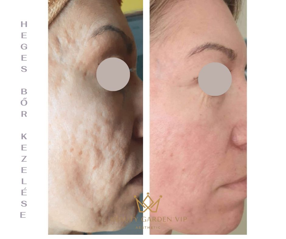 termikus ionizacio velemeny hegkezelés