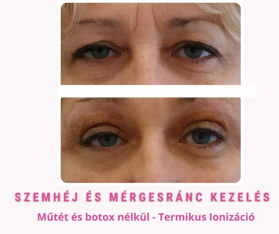 Btx helyett plasztika nelkul