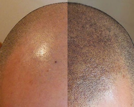 ELitscalp by FMP Professional fejbőrtetoválás nőknek és férfiaknak Budapest