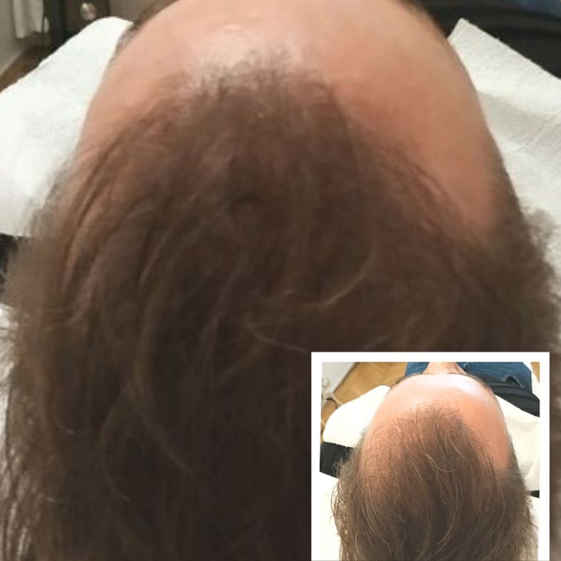 hajtetoválás hajbeültetés utan Budapest