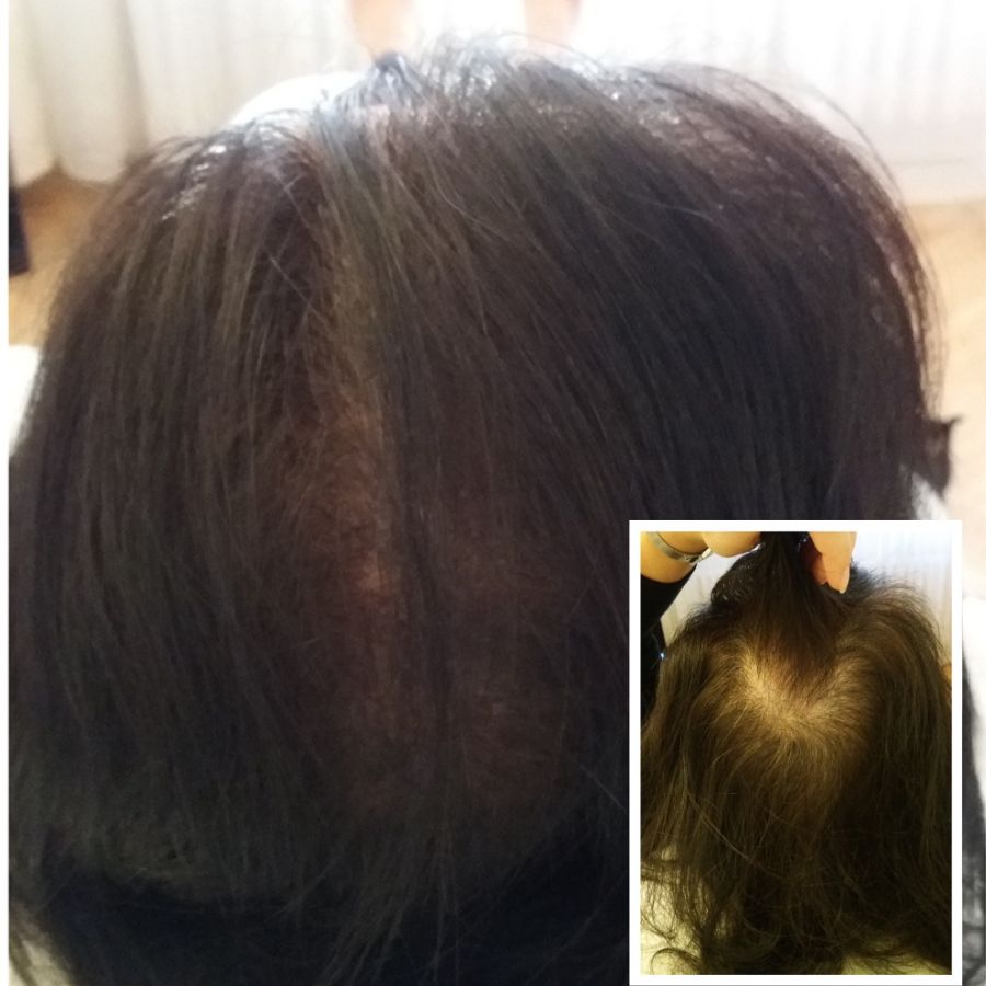 ELitscalp hajtetovalas noknek kopaszság ellen