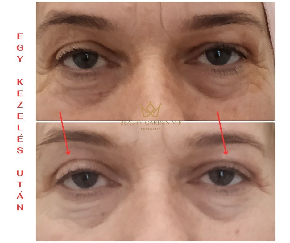 Termikus Ionizacio szemhej plasmage szemhej elotte utana