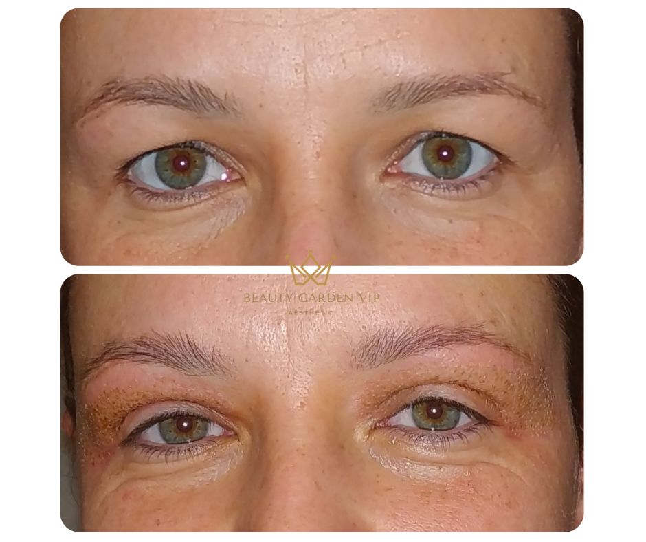 termikus ionizacio budapest előtte utána eredmény