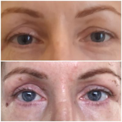 termikus ionizacio budapest